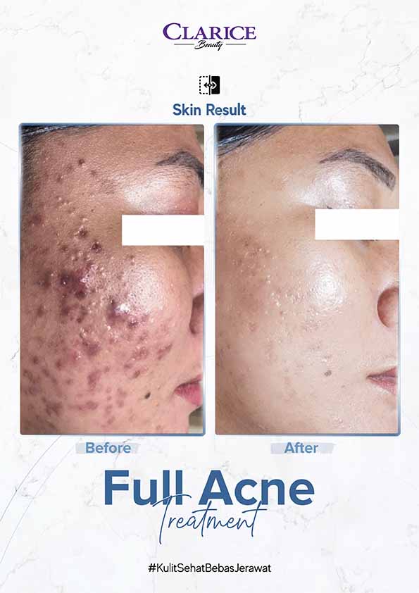 BA--Acne Candi (8) copy