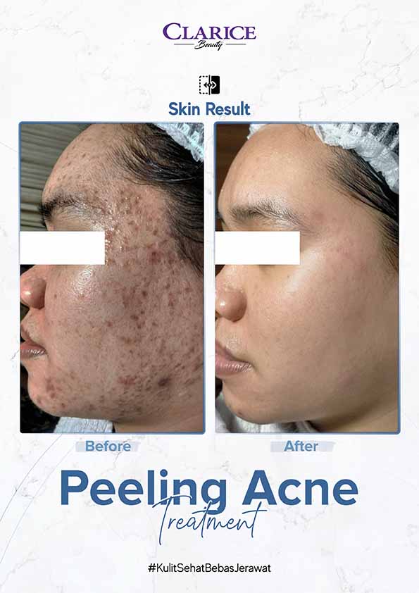 Ba--Peeling 15 Jan (2) copy