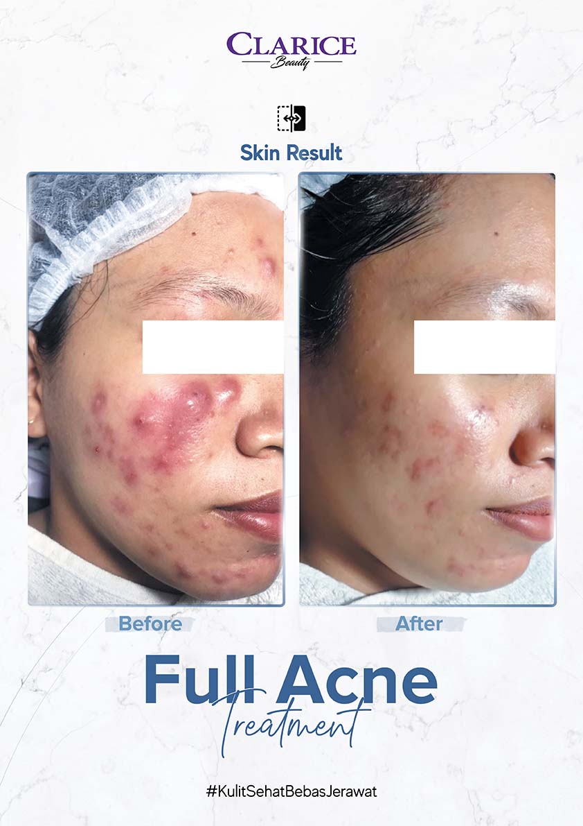 A3 BA--ACNE (7) copy