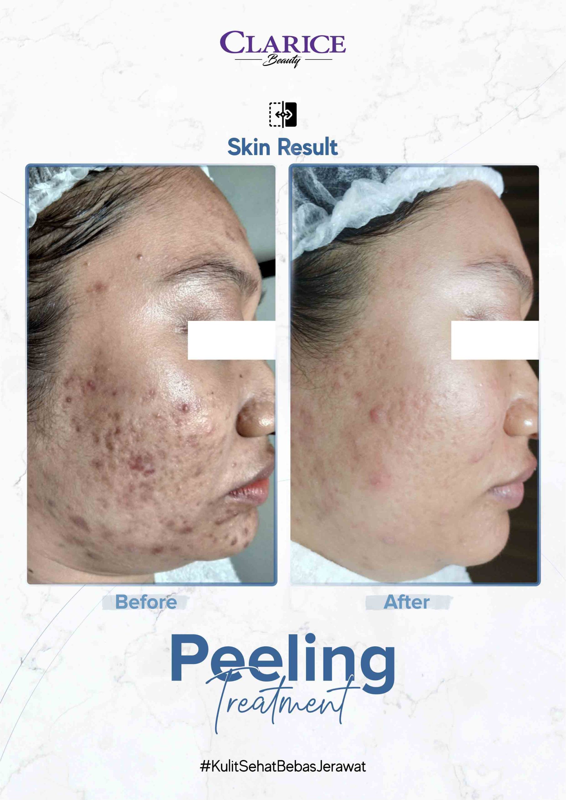 BA--Peeling--2024 (2) copy