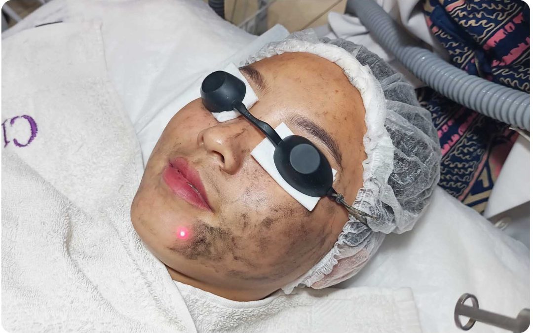 LASER TREATMENT